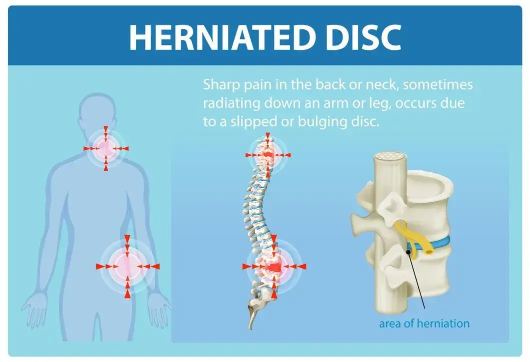 How Long Does a Herniated Disc Take to Heal? Timeline & Tips